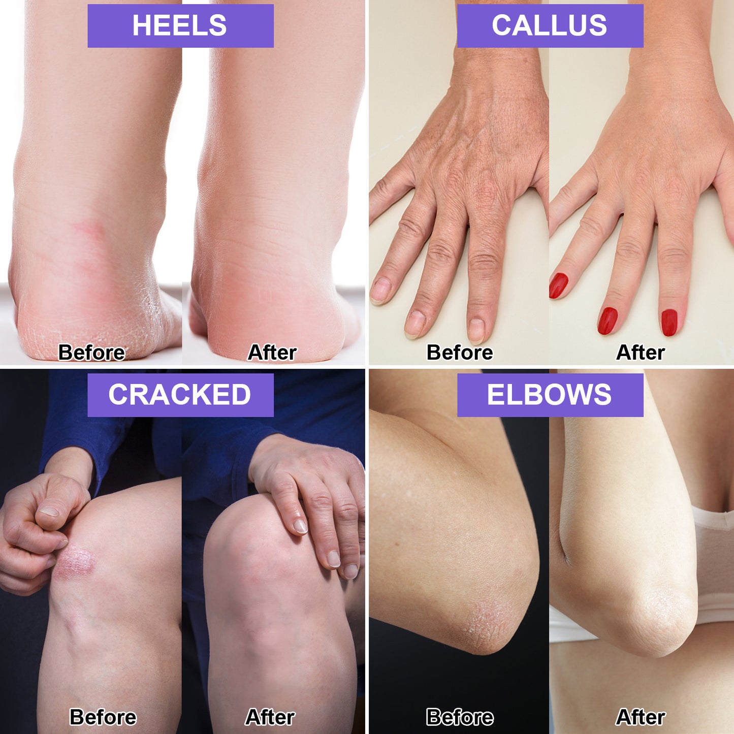 ISSUWEN Lavender Urea Cream 42% with Salicylic Acid 2% and Lavender for Cracked Heels, 2 Pack