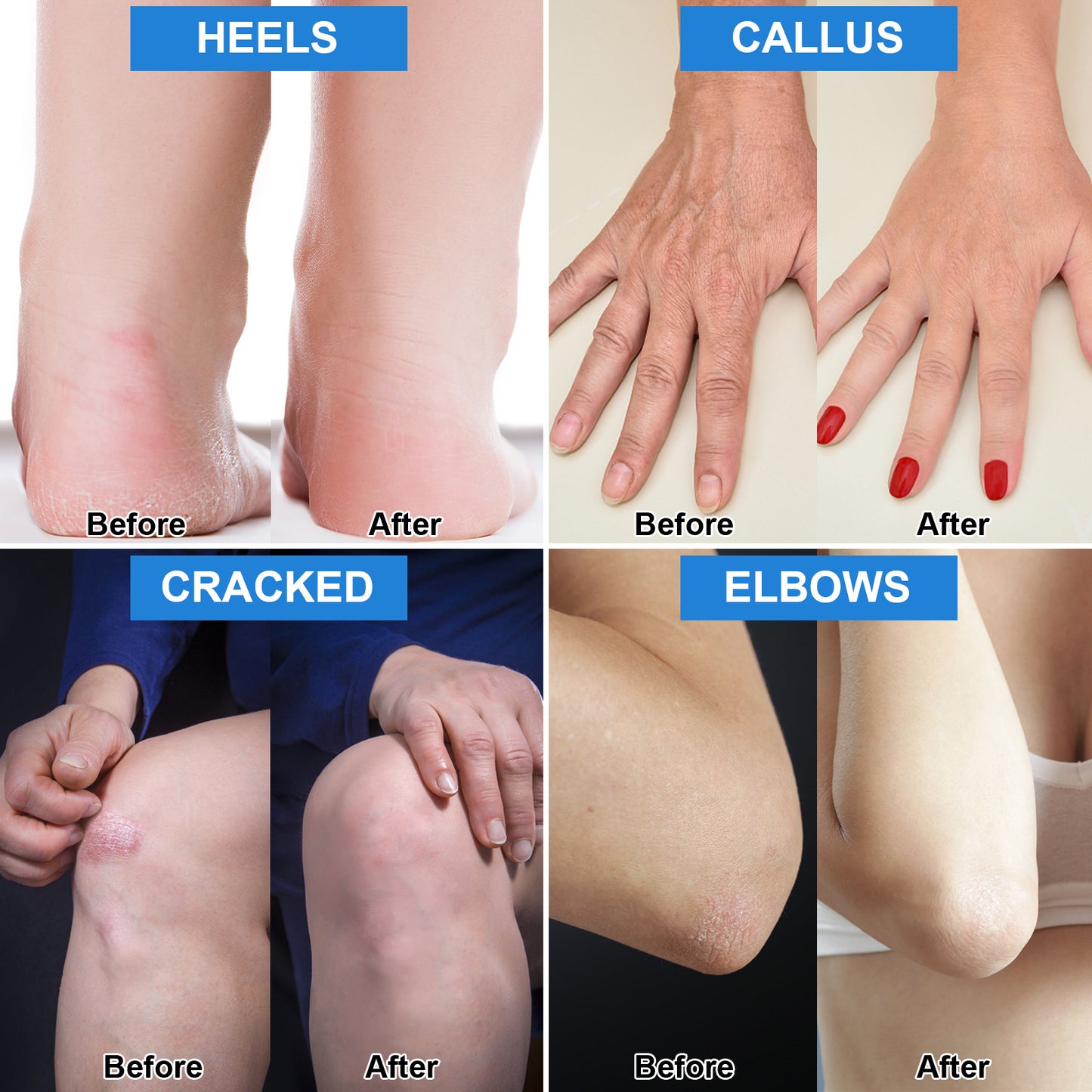 ISSUWEN Urea Cream 42% with Salicylic Acid 2% for Cracked Heels, 2 Pack